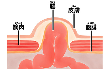 鼠経ヘルニアのイラスト