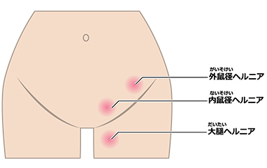 鼠径ヘルニアの種類のイラスト