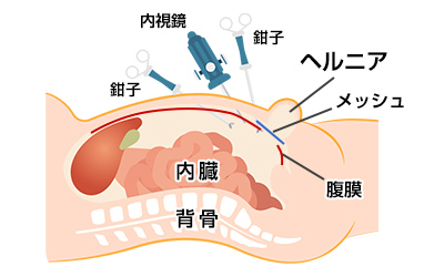 腹腔鏡下ヘルニア修復術（TAPP法）のイメージイラスト